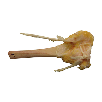 Femur Distal