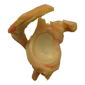 Glenoid w labrum