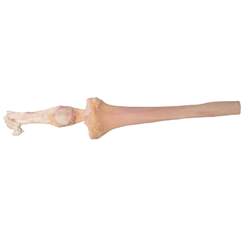 Tibia Graft