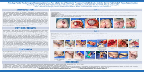 A Backup Plan for Plastic Surgical Reconstruction when Plan A Fails: Use of Aseptically Processed Meshed Reticular Acellular Dermal Matrix in Soft Tissue Reconstruction | Michael N. Desvigne, MD