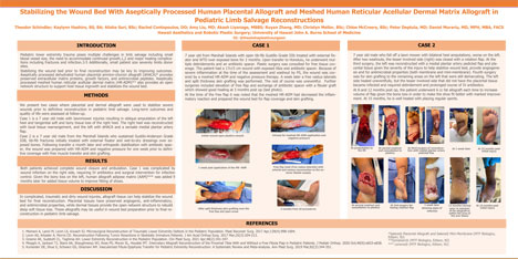 Stabilizing the Wound Bed With Aseptically Processed Human Placental Allograft and Meshed Human Reticular Acellular Dermal Matrix Allograft in Pediatric Limb Salvage Reconstructions | Daniel Murariu, MD