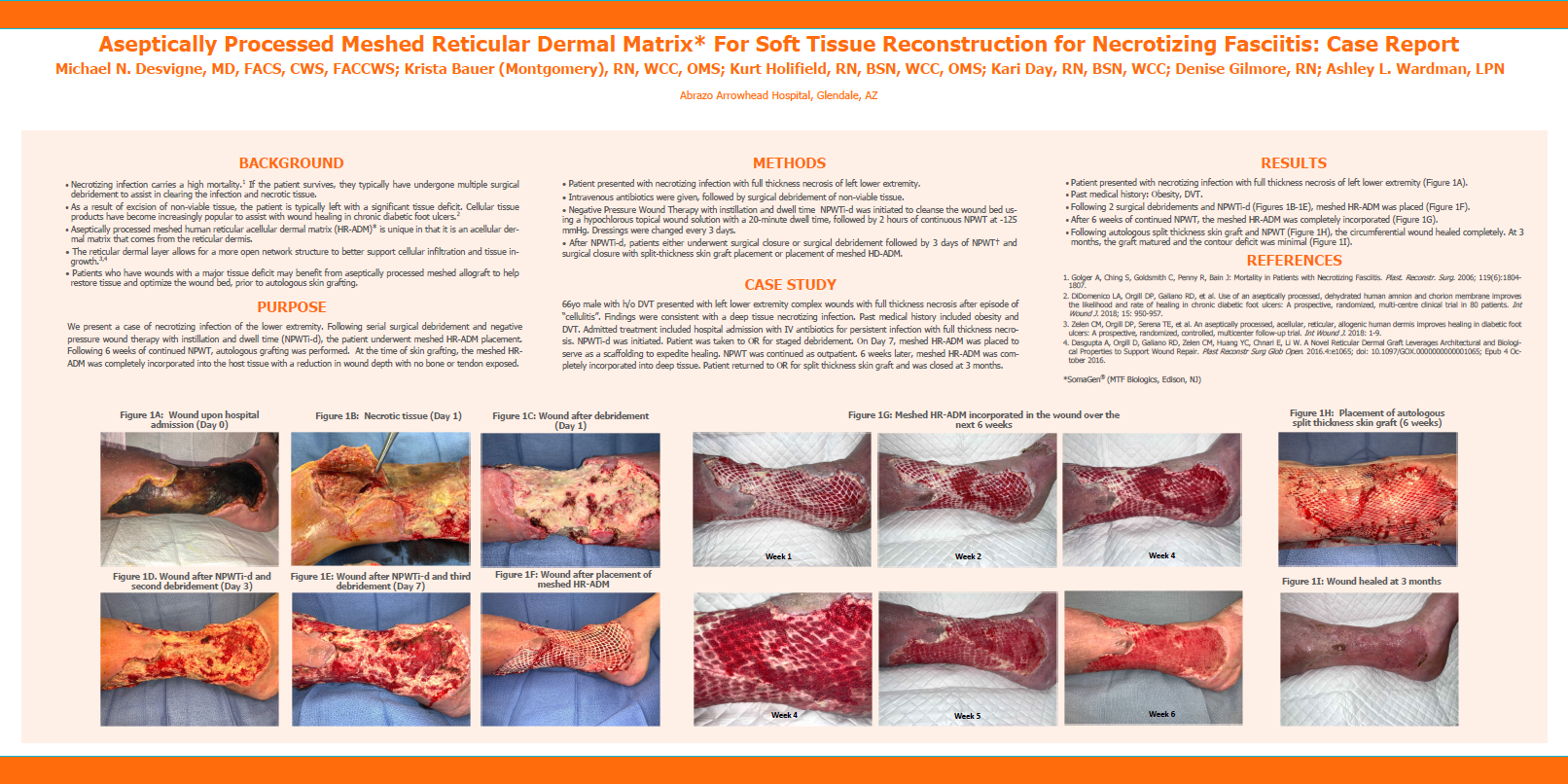 Desvigne M., Bauer K., Holifield K., Day K., Gilmore D., Wardman A. Aseptically Processed Meshed Reticular Dermal Matrix* For Soft Tissue Reconstruction for Necrotizing Fasciitis: Case Report. SAWC 2020 Fall.